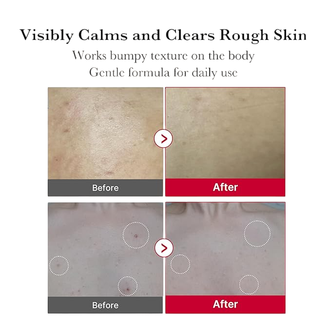 Medicube Red Acne Body Peeling Shot 2.0 110g